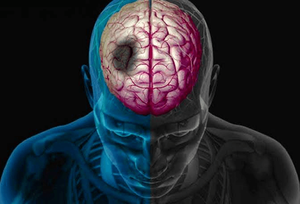 هر دقیقه تأخیر، جان بیمار سکته مغزی را تهدید می‌کند