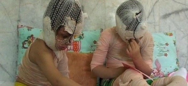 سوختگی نازنین زهرا و فرزانه