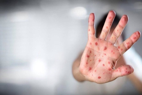 آبله میمونی