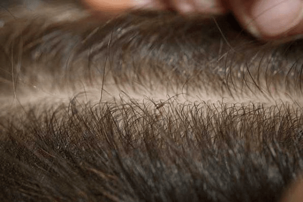 دانش‌آموزان چگونه از ابتلا به شپش سر پیشگیری کنند